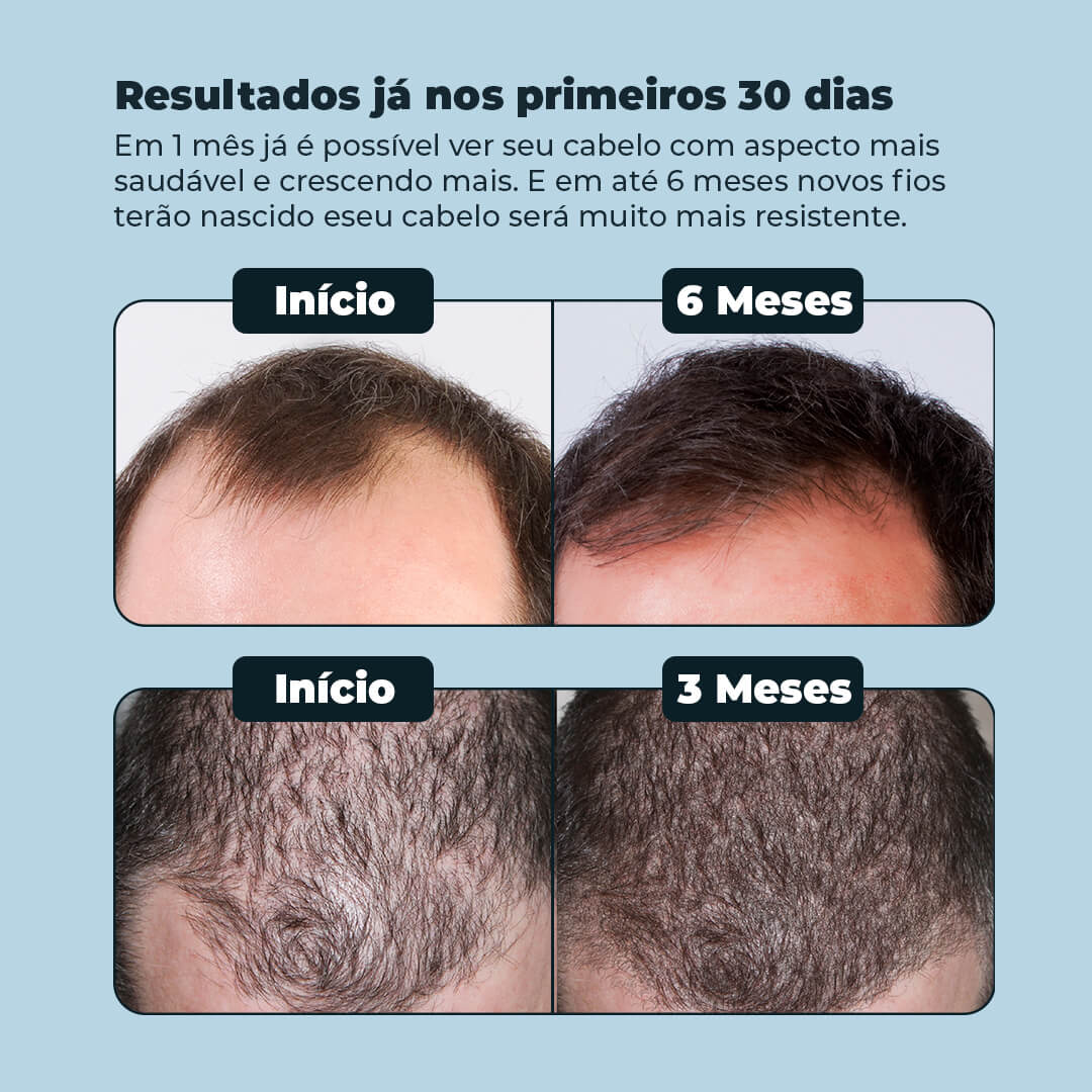 Kit Tratamento Intensivo (6 Meses)